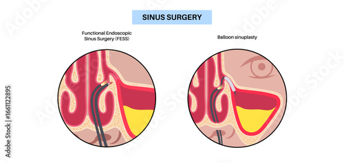 Minimally invasive endoscopic procedures