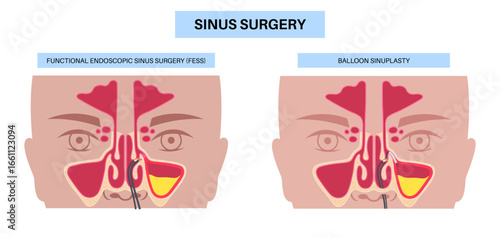 Minimally invasive endoscopic procedures
