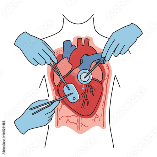 Heart Surgery Illustration: Hands with Surgical Tools Performing a Medical Procedure.