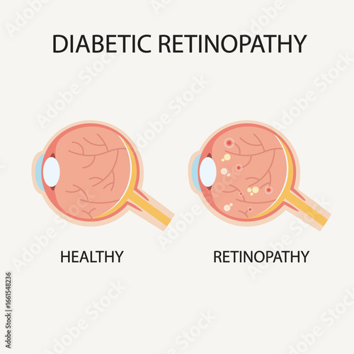 Vector illustration of diabetic retinopathy showing symptoms like blurred vision, dark spots, and vision loss. Includes comparison with similar eye diseases like macular degeneration con