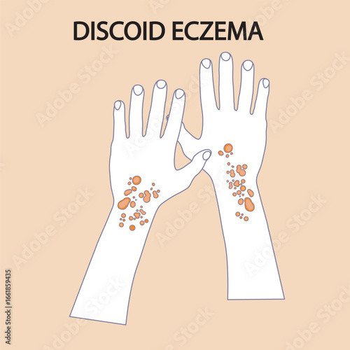 Vector illustration of discoid eczema showing round, itchy, scaly patches. Highlights symptoms and helps distinguish from similar conditions like ringworm and psoriasis icon