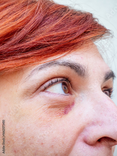 Foto Close up of a woman's eye showing bruising and distress reflecting the silent suffering experienced in domestic violence situations impacting women worldwide
