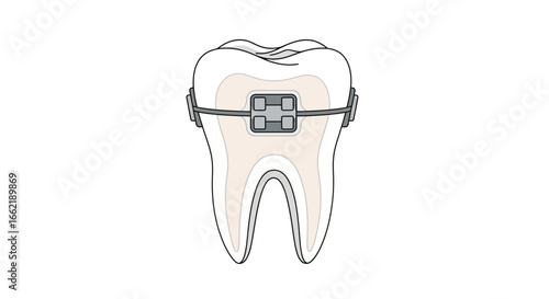 Vector illustration of a single tooth with dental braces, depicting the orthodontic process for teeth straightening and achieving an aligned, healthy smile