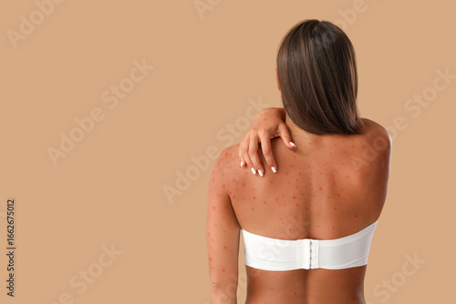 Fotografie Young woman ill with chickenpox on beige background, back view