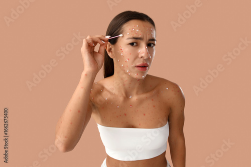 Young woman ill with chicke...