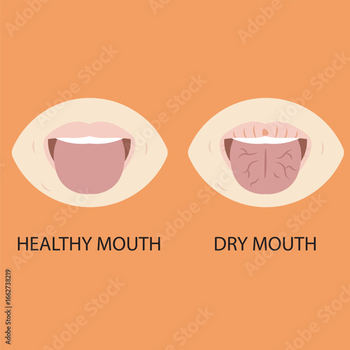 Vector illustration of dry mouth, showing thirst, sticky saliva, bad breath, cracked lips, and sore throat; highlights similar conditions like dehydration, Sjögren’s syndrome, diabetes.icon