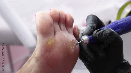 Close-up removal of calluses on the foot using a medical instrument.