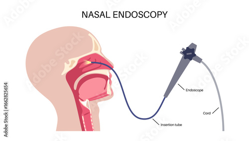 Nasal endoscopy poster