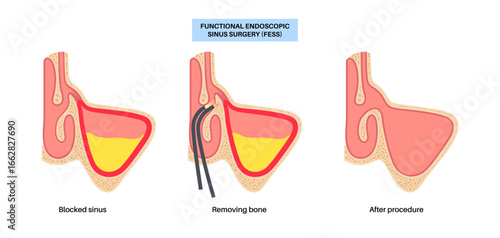 Functional Endoscopic Sinus Surgery