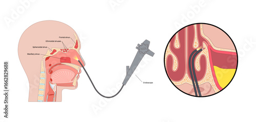 Functional Endoscopic Sinus Surgery