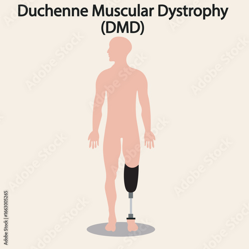 Vector showing Duchenne muscular dystrophy: progressive muscle weakness, calf enlargement, gait issues. Highlights symptoms vs similar disorders like Becker MD and limb-girdle MD leg, disability