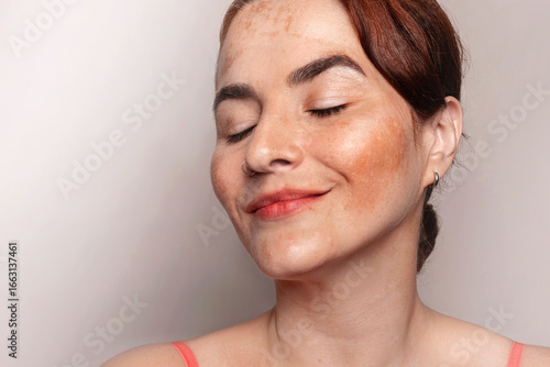 Woman smiles and likes her face with pigmentation, melasma, freckles, age spots photo. Close up photo