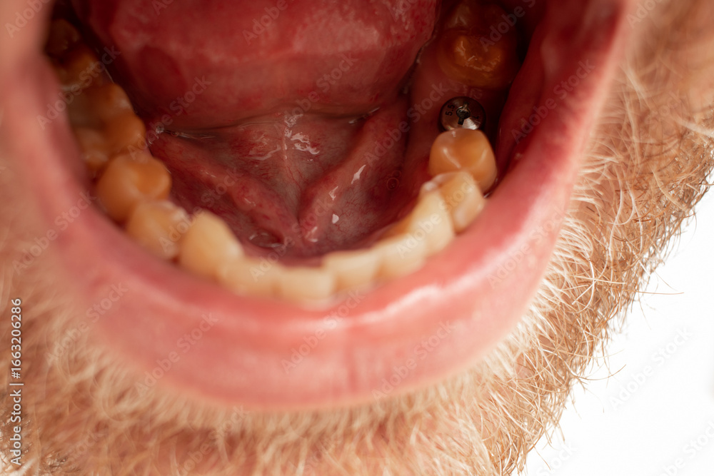 Obraz premium gum shaper installation operation. Open mouth.