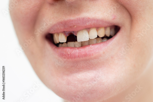 Young woman smiling without a front tooth. Implant placement surgery. front tooth extraction, bone grafting