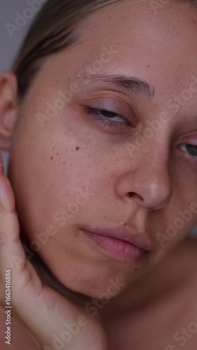 Vertical video of a young caucasian woman showing dark circles under her eyes with hand. Pale skin, bruises under the eyes are caused by disease, fatigue, lack of sleep, insomnia, stress
