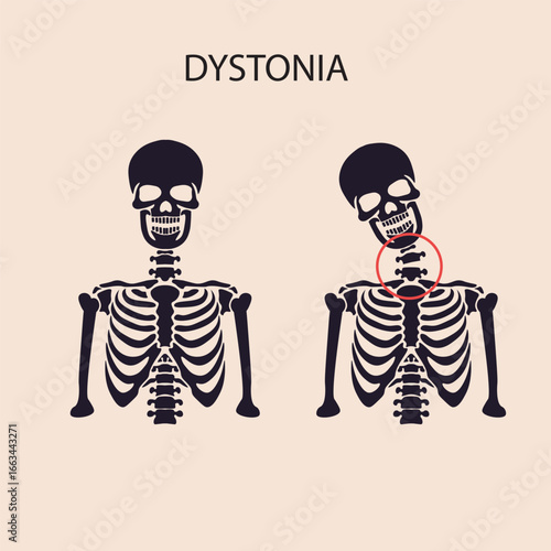 Vector showing dystonia: involuntary muscle contractions, twisting, tremors, abnormal postures; compared with Parkinson’s, tremor disorders, cerebral palsy. silhouette skeleton