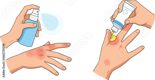 Hand applying burn treatment, using spray and ointment, first aid for skin injury, healing burn wounds, skin care, infection prevention, healthcare medical illustration