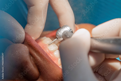 Fotografi Close-up of tooth surface preparation for veneer placement with rotary dental drill and water cooling