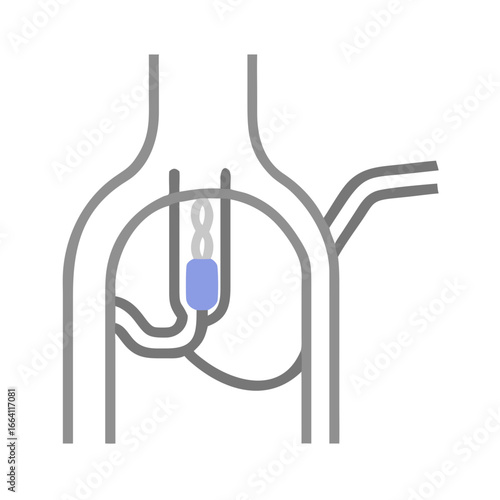 Medical schematic illustration of coronary artery bypass grafting CABG