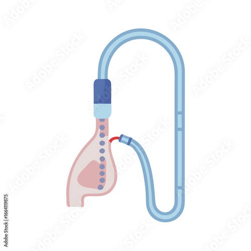 Medical Diagram Showing Dialysis Procedure with Blue Tubing System