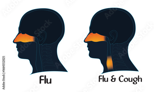 Influenza Symptoms Nasal Congestion and Throat Irritation