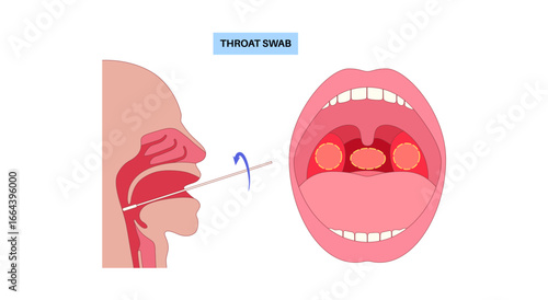 Swab throat procedure