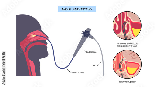 Nasal endoscopy poster
