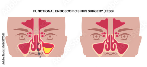 Functional Endoscopic Sinus Surgery