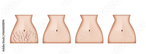 Woman body before and after stretch marks removal treatment
