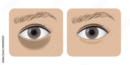 Removing dark circles and bags under eyes, before and after effect