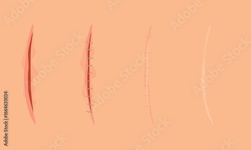 Set of healing wounds, skin scars, stitched gash and cuts