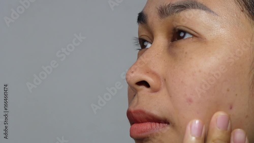 An Asian woman pointing at acne and blemishes on her cheek, showing skin problems and facial imperfections.