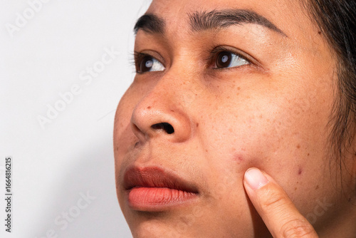 An Asian woman pointing at acne and blemishes on her cheek, showing skin problems and facial imperfections.