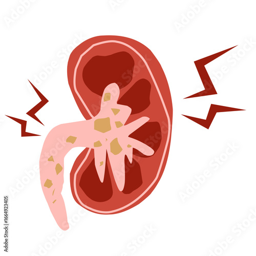 Kidney stone illustration animation 