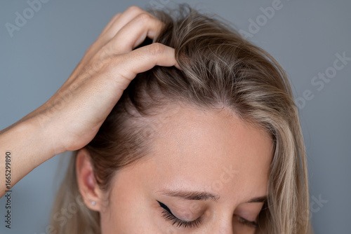 Εκτύπωση καμβά Close-up of a young woman's scalp with visible thinning hair and receding hairline