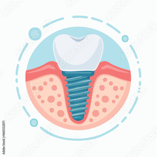 Cross-section of a dental implant showing the anatomical structure of the crown, screw, and integration with the gum and jawbone. Flat vector illustration