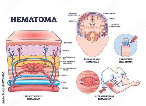Hematoma_Diagram_outline shows types of hematomas with labeled sections of skin, brain, and finger, highlighting blood accumulation, transparent background.