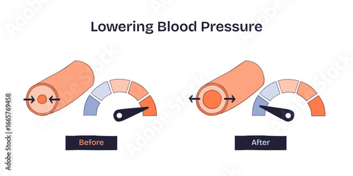 Lowering blood pressure is shown by comparing narrowed and widened blood vessels with gauge indicators before and after, transparent background. Doodle style diagram