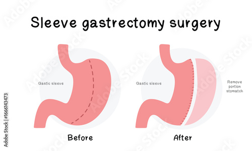 Illustration sleeve gastrectomy surgery