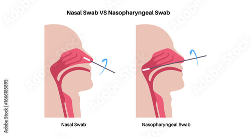 Nasopharyngeal and nasal swab