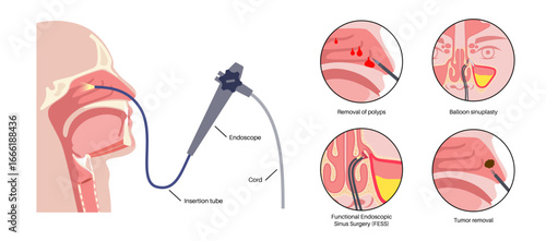 Nasal endoscopy poster