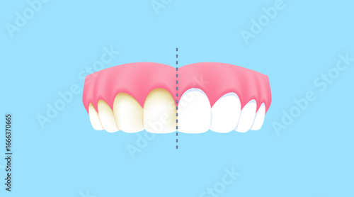 Upper teeth - Yellow (Before and After Comparison) illustration vector design. Dental care concept.
