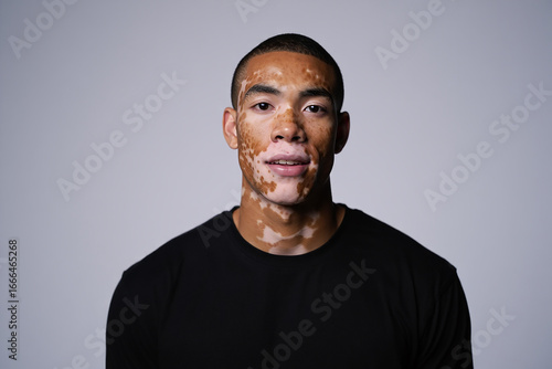 Portrait of a young man with vitiligo skin condition