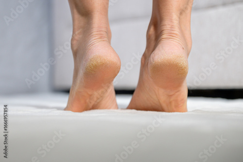 Wallpaper Mural A close-up of human heels with cracked and dry skin, showing callus and rough texture. Concept of foot care, cracked heel problem, dermatology, healthcare, skin treatment, and wellness. Torontodigital.ca