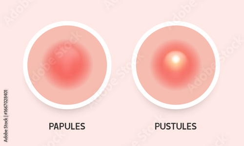 Pustule and papule. Types of acne. Vector illustration