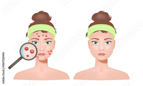 Acne skin and healthy skin. Girl with acne. Vector illustration