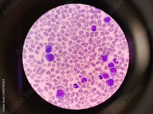 Human blood pathology with myelocytes under microscope