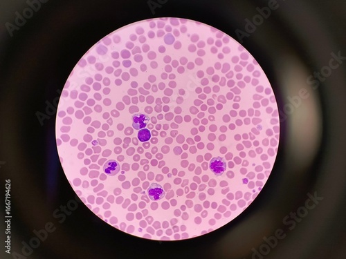 Human blood smear showing blast cell under microscope
