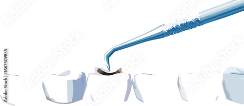 Dental tool examining cavity in educational vector for oral health promotion
Vector illustration of dental checkup highlighting tooth decay for youth education