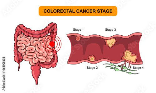 Illustration of colorectal cancer stages. Concept of colon cancer progression. Spread of tumor to lymph nodes. Medical vector illustration for clinics, education, and science.